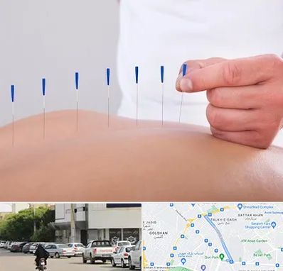 دکتر طب سوزنی در قدوسی شرقی شیراز