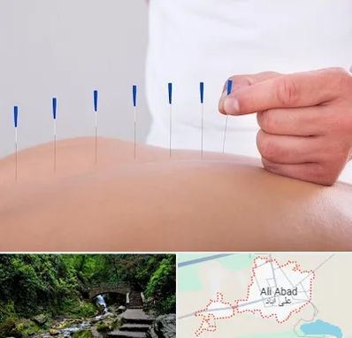 دکتر طب سوزنی در علی آباد کتول