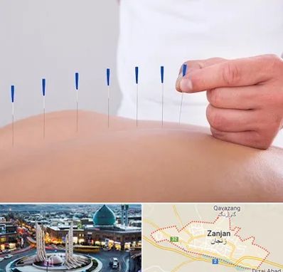 دکتر طب سوزنی در زنجان