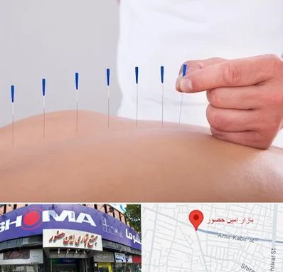 دکتر طب سوزنی در امین حضور