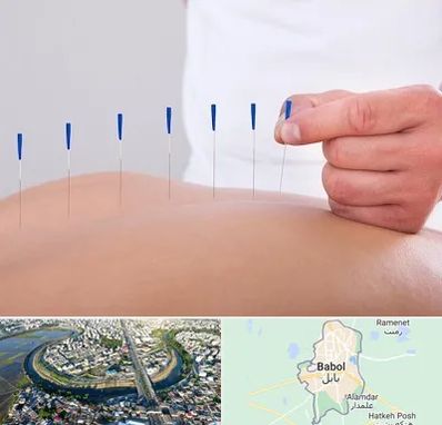 دکتر طب سوزنی در بابل