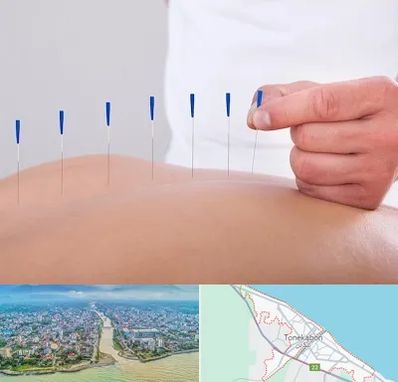 دکتر طب سوزنی در تنکابن