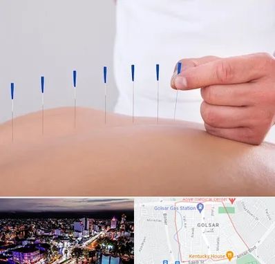 دکتر طب سوزنی در گلسار رشت