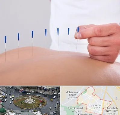 دکتر طب سوزنی در فردیس کرج 