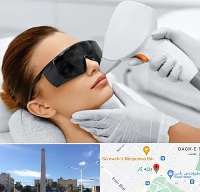 مرکز لیزر مو در فلکه گاز شیراز