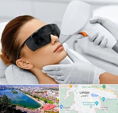 مرکز لیزر مو در لاهیجان