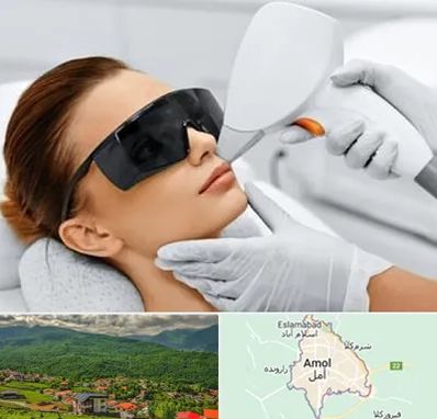 مرکز لیزر مو در آمل