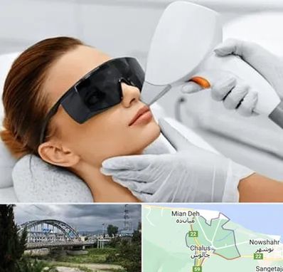 مرکز لیزر مو در چالوس