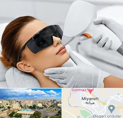 مرکز لیزر مو در میانه
