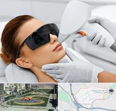 مرکز لیزر مو در مرزداران تبریز