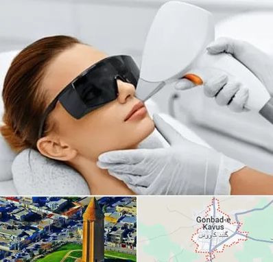 مرکز لیزر مو در گنبد کاووس