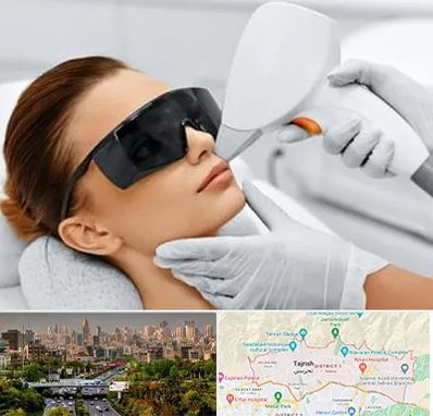 مرکز لیزر مو در منطقه 1 تهران