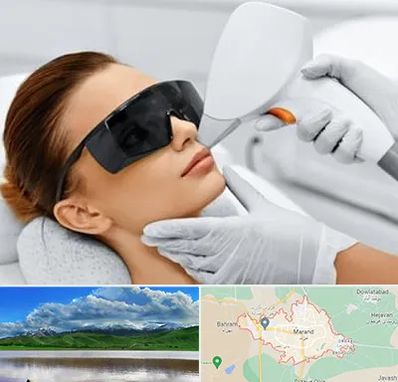 مرکز لیزر مو در مرند