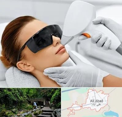مرکز لیزر مو در علی آباد کتول