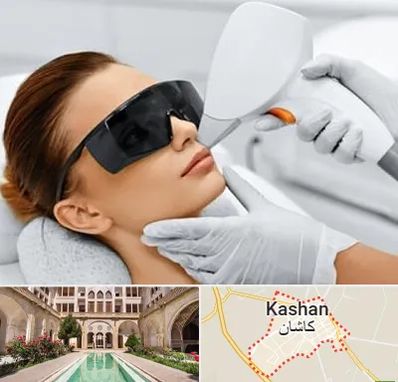 مرکز لیزر مو در کاشان