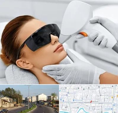 مرکز لیزر مو در ضیابری رشت