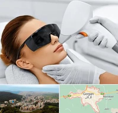 مرکز لیزر مو در گرگان