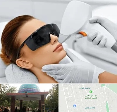 مرکز لیزر مو در کیانشهر