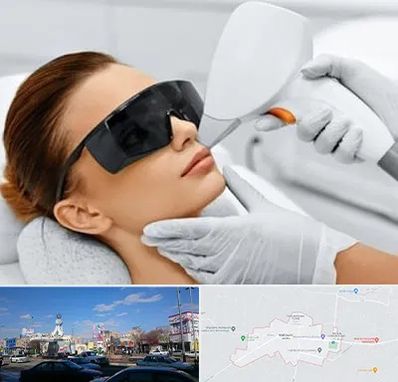 مرکز لیزر مو در ماهدشت کرج