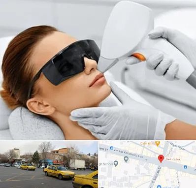 مرکز لیزر مو در شهناز تبریز
