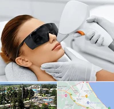 مرکز لیزر مو در رودسر