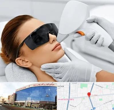 مرکز لیزر مو در نصف راه تبریز