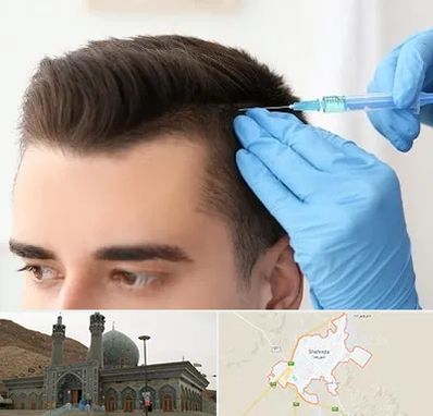 مزوتراپی مو در شهرضا