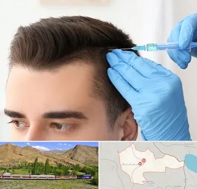 مزوتراپی مو در خاش