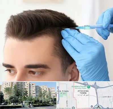 مزوتراپی مو در آپادانا