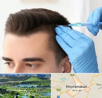 مزوتراپی مو در خرم آباد