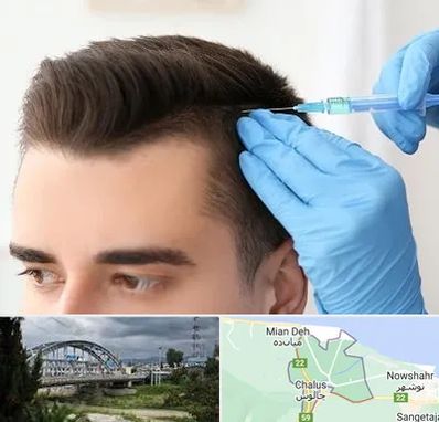 مزوتراپی مو در چالوس