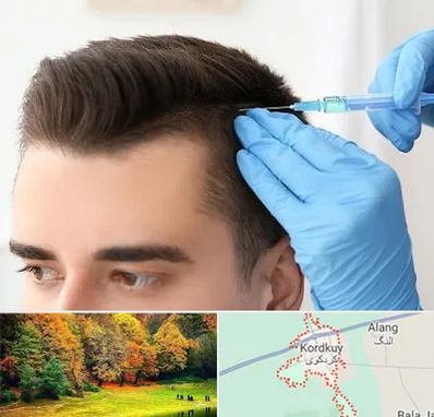 مزوتراپی مو در کردکوی