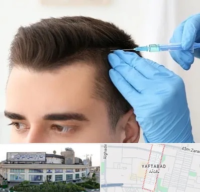 مزوتراپی مو در یافت آباد
