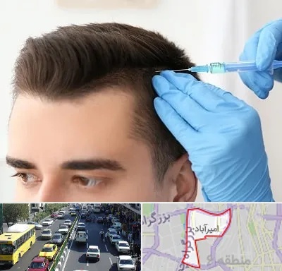 مزوتراپی مو در امیرآباد