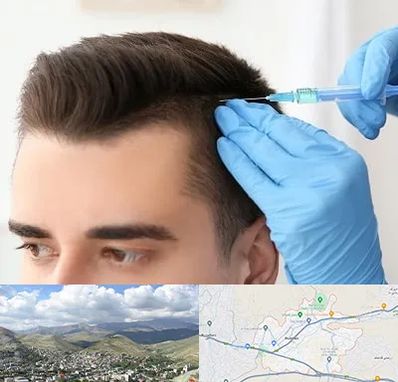 مزوتراپی مو در رودهن