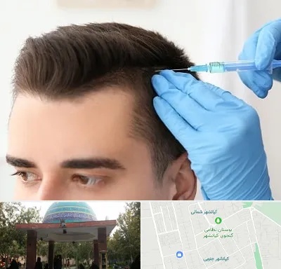 مزوتراپی مو در کیانشهر