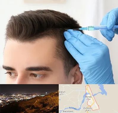 مزوتراپی مو در میناب