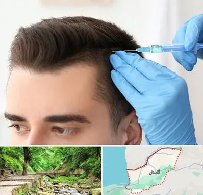 مزوتراپی مو در گلستان