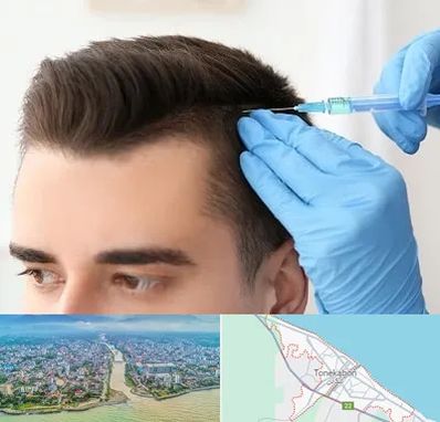 مزوتراپی مو در تنکابن