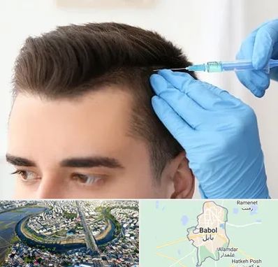 مزوتراپی مو در بابل