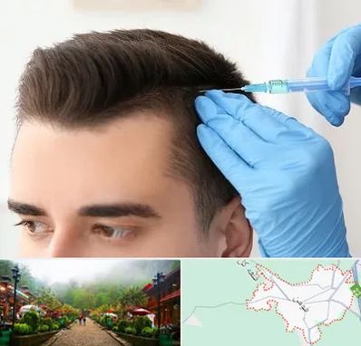 مزوتراپی مو در فومن