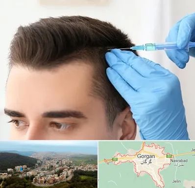 مزوتراپی مو در گرگان