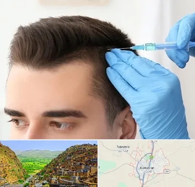 مزوتراپی مو در کامیاران