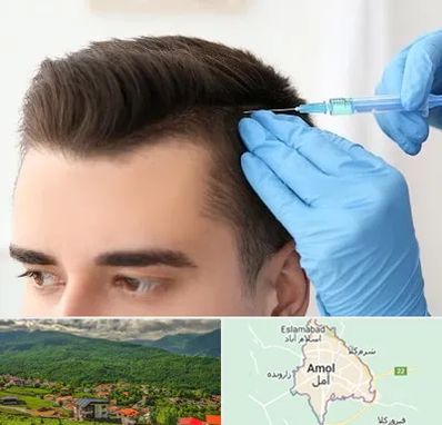 مزوتراپی مو در آمل