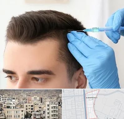 مزوتراپی مو در اسکندری