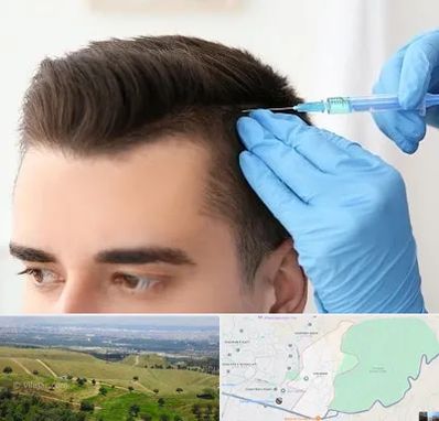 مزوتراپی مو در سوهانک