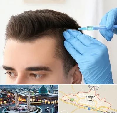 مزوتراپی مو در زنجان