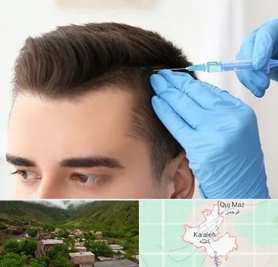 مزوتراپی مو در کلاله