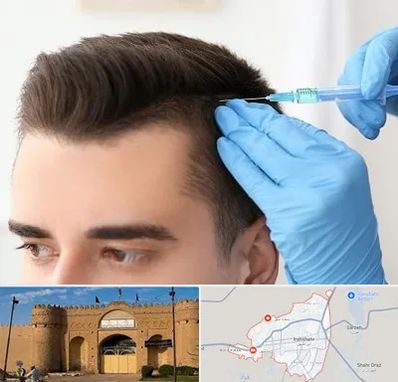 مزوتراپی مو در ایرانشهر