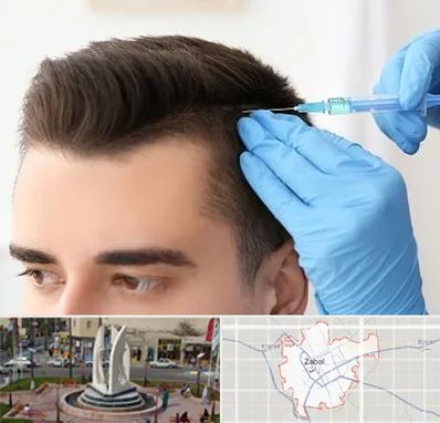 مزوتراپی مو در زابل